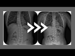 Calcium Deficiency Causing Scoliosis?  Vegans Should Know!