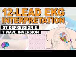 Myocardial Ischemia - ST Depression & T Wave Inversion - 12-lead EKG