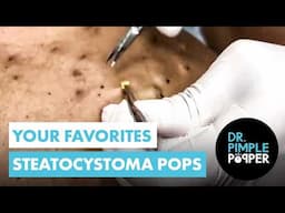 The Ultimate Steatocystomas Compilation of Dr Pimple Popper