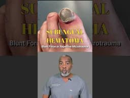 Subungual hematoma #subungualhematoma #toeinjury #feet #podiatry #footcare