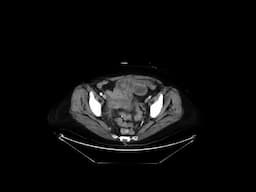 Gallstone ileus