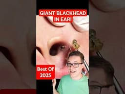 (TW) Shockingly Big EAR BLACKHEAD REMOVAL #shorts