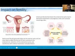 Fibroids & Fertility: Your Path To Parenthood