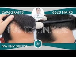 Hair Graft Technique FUE Grafts 2696 (6620 Hairs)