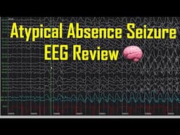 Atypical Absence Seizure EEG Review