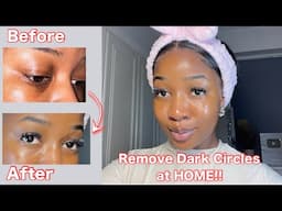 HOW TO GET RID OF DARK CIRCLES IN A WEEK | DIY Brightening Eye Mask | * Pictures included *