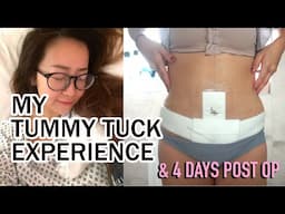 MY TUMMY TUCK EXPERIENCE & 4 DAYS POST OP | Q&A