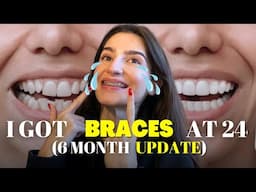 THIS IS HOW LIFE LOOKS LIKE WHEN HAVING BRACES | 6 MONTH UPDATE