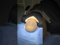 Right after a hair transplant #vincihairclinic #hairtransplant #shorts