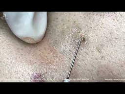 Big Cystic Acne Blackheads Extraction Blackheads & Milia, Whiteheads Removal Pimple Popping