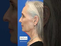 Vertical Restore Facelift Transformation to FIX a Sagging Neckline!