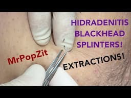 Have you ever seen Splinter Blackheads extracted before!? Check it out! Oxidized plug removal.