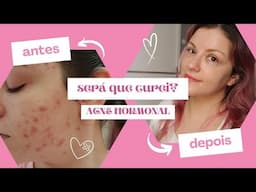 Curei a acne depois de 20 anos? 😱 (mas o Roacutan falhou!) [Mari Santarem]