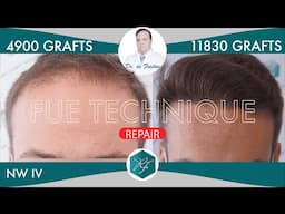 Hair Graft Repair FUE Grafts 4900 (11830 Hairs)