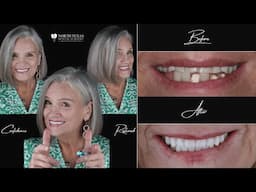 All-on-4 Dental Implant Journey