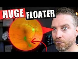 What Causes This Huge Eye Floater!? PVD Treatments Explained