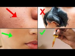 How to Remove Blackheads | GUARANTEED METHOD!!!