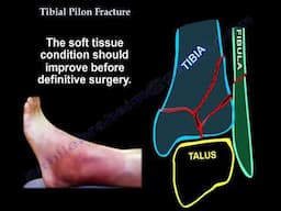 Tibial Pilon Fracture