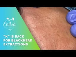 K Is Back for Blackhead Extractions