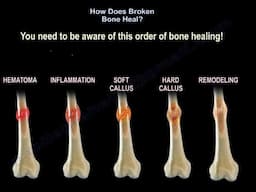 Fracture Healing: How Bones Heal: Types, Stages, and Key Factors