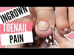 Painful Ingrown Toenails Causes