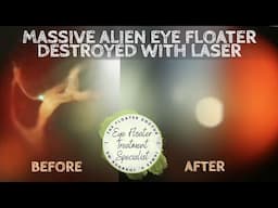 Huge Alien Eye Floater Destroyed with Laser. YAG Laser Vitreolysis Specialist