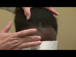 African Curly Hair Transplant Repair