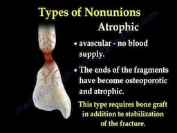 NONUNION OF FRACTURES CAUSES, TYPES AND TREATMENT