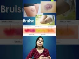 Bruise(त्वचा पर नीले धब्बे होना ) क्यों होते है ? #shorts #bruise