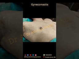 Gynecomastia Grade 1 Surgery #lipo #gynecomastiasurgeryindia #cosmeticsurgery #beforeandafter