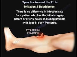 Managing Open Tibial Fractures: Key Facts and Approaches