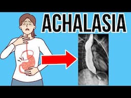 Doctor explains Achalasia | Definition, causes, symptoms, treatment, surgery