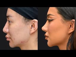 My 4th Nose Job Surgery Story! Nikita Dragun