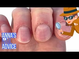 Overcoming nail bitting and picking for an upcoming wedding [Anna's Nail Advice]