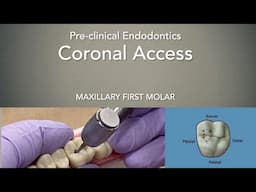 Coronal Access (Maxillary First Molar)