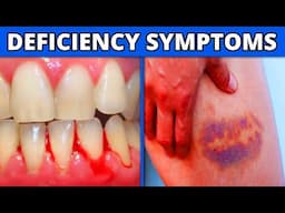 Vitamin C Deficiency Symptoms | What Happens If Your Vitamin C Is Low?