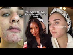 tiktok trends r DAMAGING your sensitive skin 💔