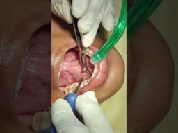 REMOVAL OF MUCOCELE USING ELECTROCAUTERY!