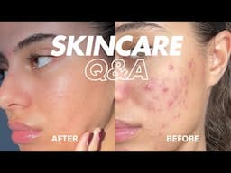 SKINCARE Q&A - HOW I CLEARED MY ACNE | Jéssica Pimentel