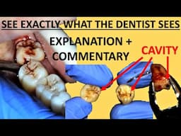 Upper and Lower Right Wisdom Tooth Removal (Extraction) - Full Surgery Walkthrough Sydney Australia