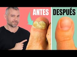 La Forma Más Rápida de Eliminar el Hongo en las Uñas de los Pies 🦶