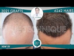 Hair Graft Technique FUE Grafts 3021 (6242 Hairs)