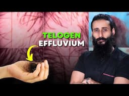 Telogen Effluvium क्या होता है? How To Treat This Hair Loss? | Bearded Chokra