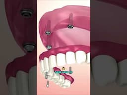 Types of Dentures