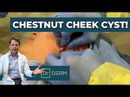 CHESTNUT Cheek Cyst! | Dr. Derm