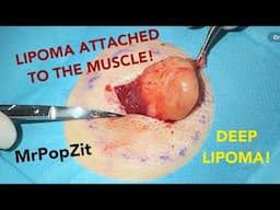 Very deep lipoma attached to muscle on back!Must see lipoma removal.My camera person almost faints!