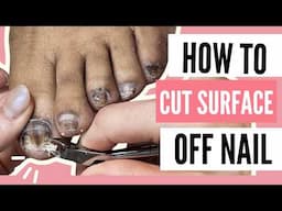 How to Fix Nail Fungus Toenails at Home No Medication