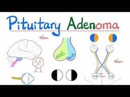 Pituitary Adenoma - Pituitary Tumors - Prolactinoma - Microadenoma, Macroadenoma - Visual Field