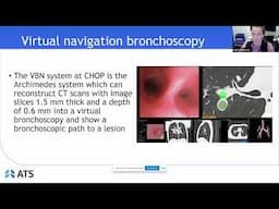 Diagnostic Yield of Endobronchial Ultrasound and Virtual CT Navigational Bronchoscopy