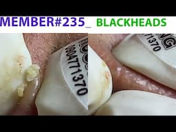 Acne Treatment Huong Da Nang #235 Remove Blackheads